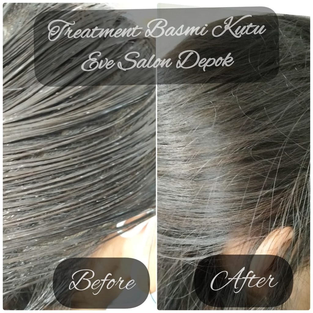 harga treatment kutu di salon cijantung