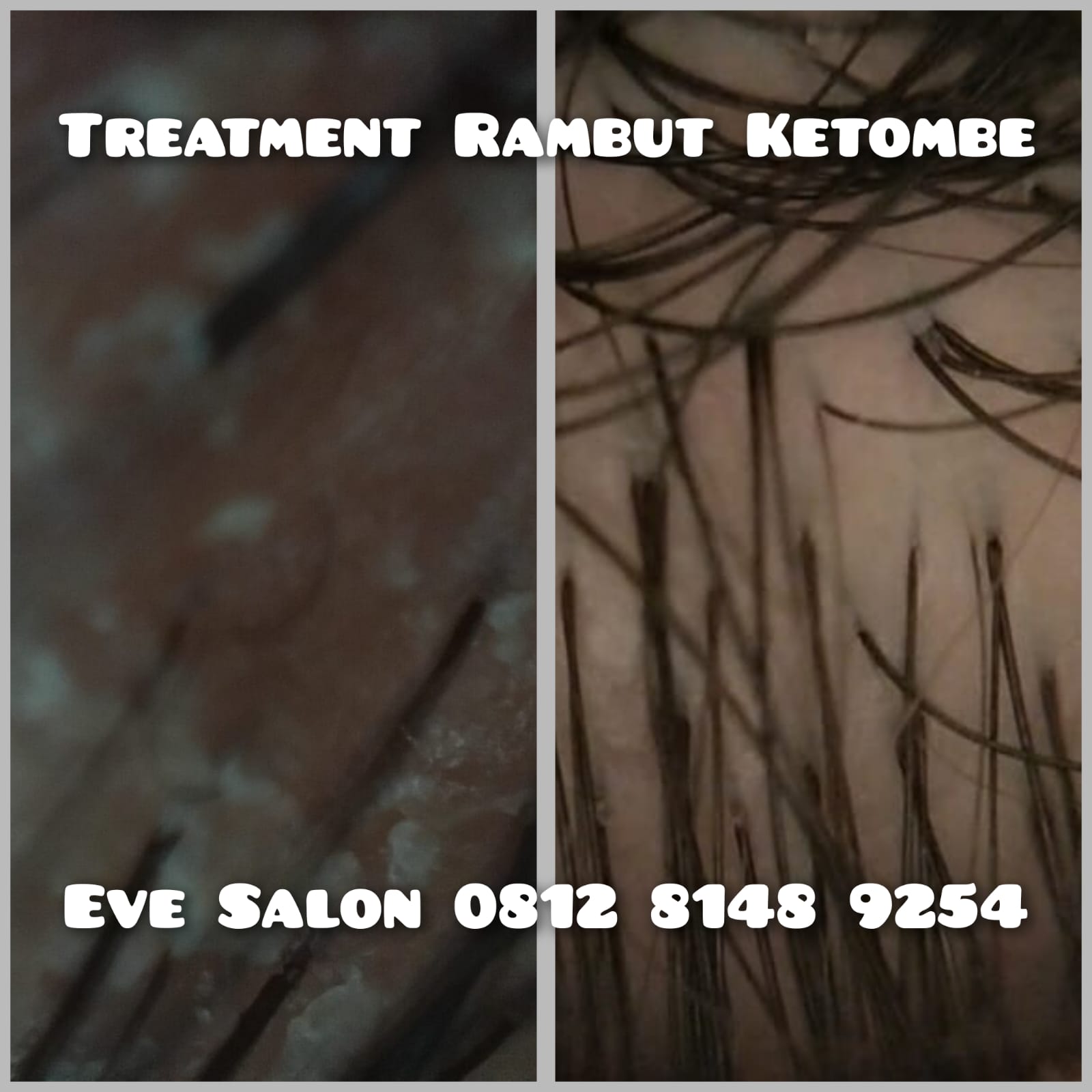 harga treatment ketombe di salon