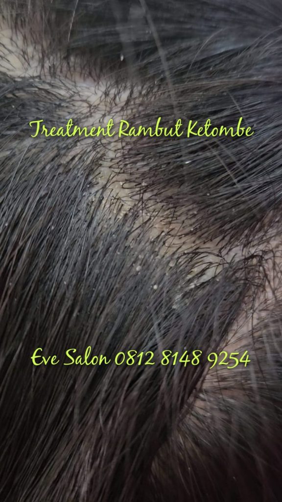 harga treatment rambut ketombe di salon