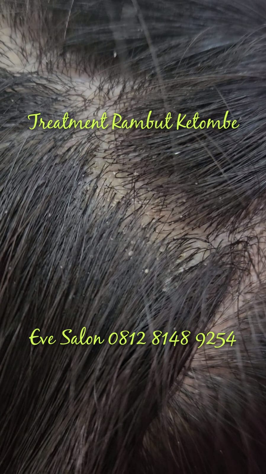 harga treatment rambut ketombe di salon