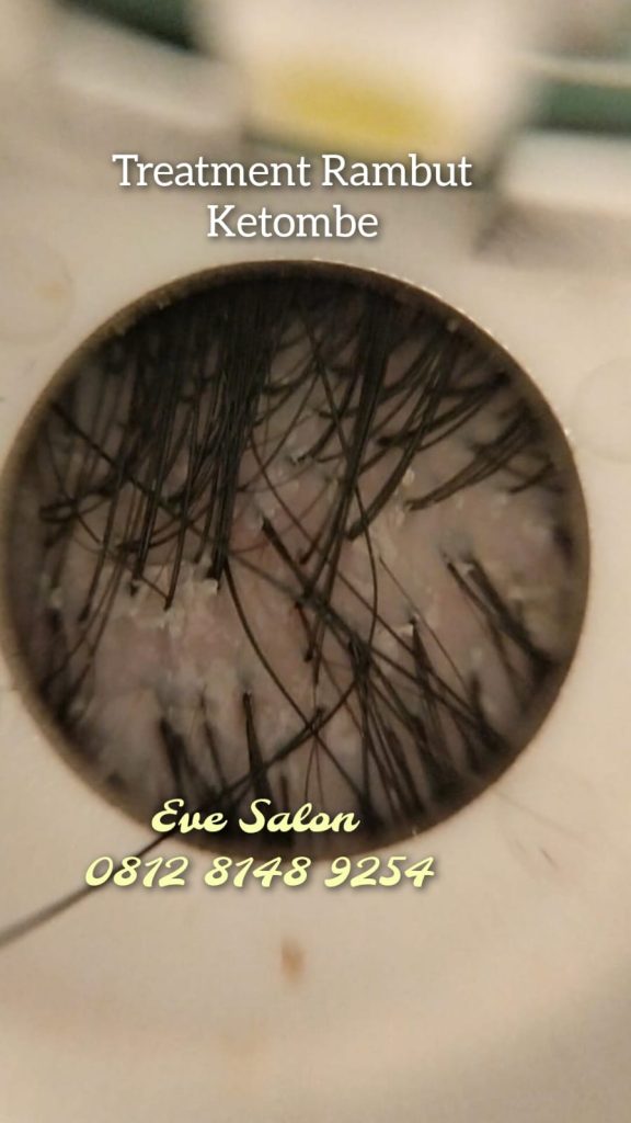 salon treatment ketombe