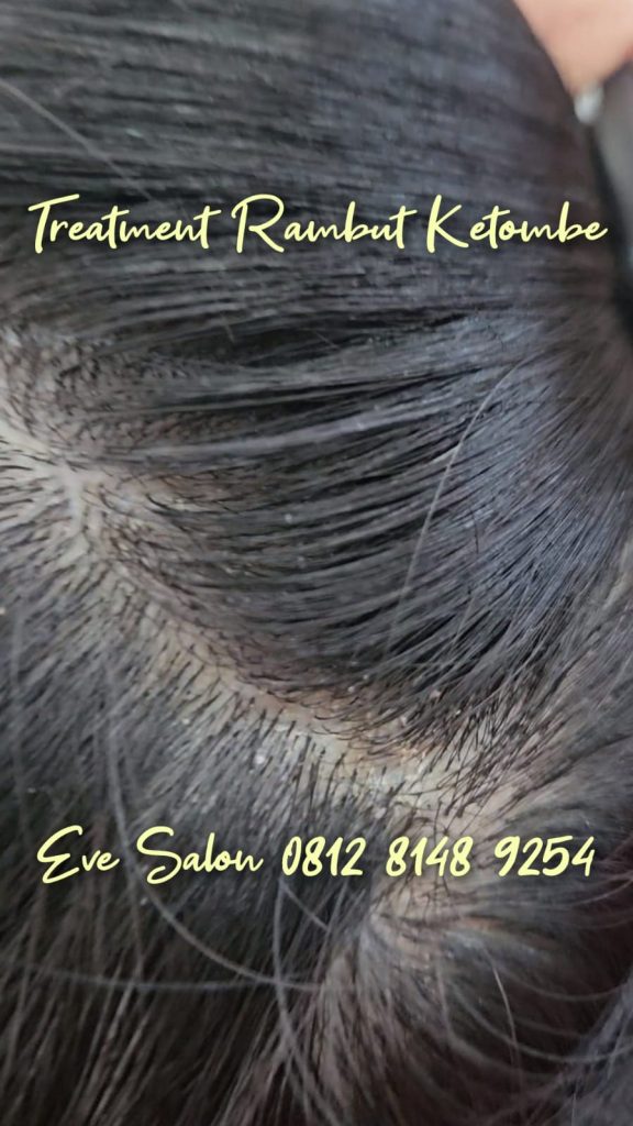 salon treatment rambut ketombe